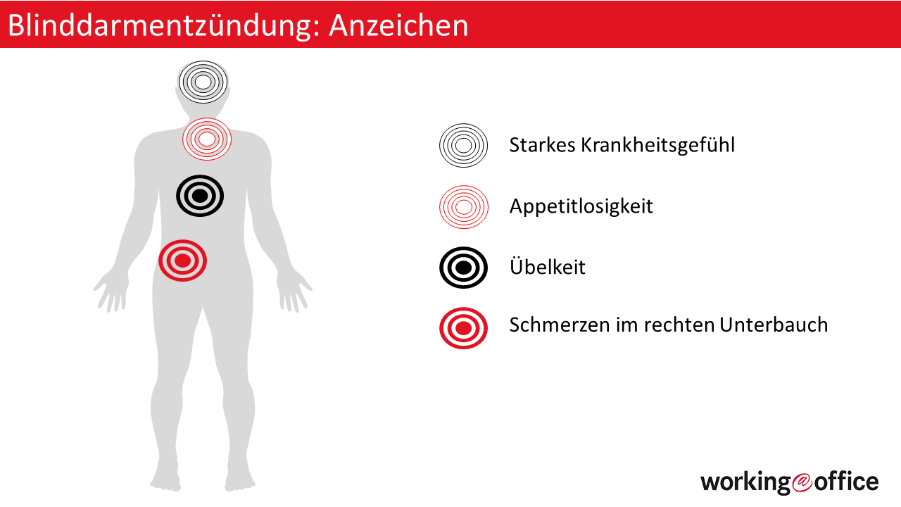 Wie lange man nach einer BlinddarmOP krankgeschrieben wird